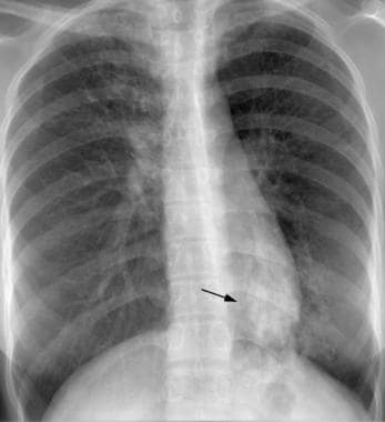 Young male patient with fever and cough has a foca