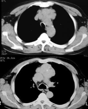 Malignant thymoma. Chest CT scan in a 61-year-old 
