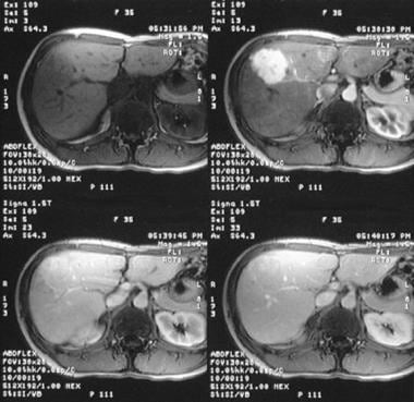 Focal Nodular Hyperplasia (FNH) Imaging and Diagnosis: Practice