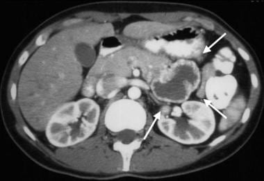 Gastrointestinal stromal tumor (GIST). Contrast-en