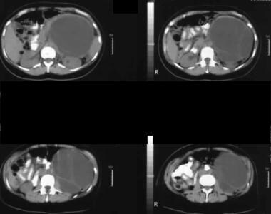 Nonenhanced axial CT scans. Image 1 shows a large 