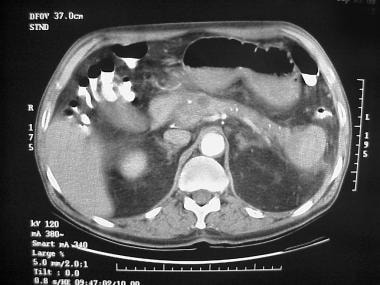 CT scan in a patient with a pancreatic pseudocyst 
