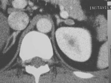Contrast-enhanced axial CT scan. A left adrenal ad