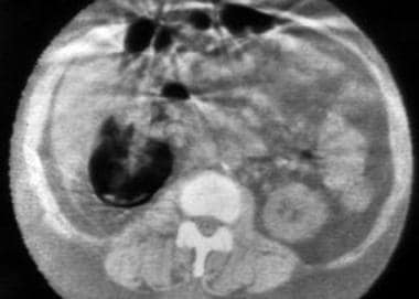 Computed tomography scan in a 58-year-old woman wi