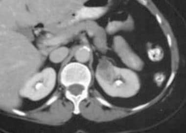 例3。小肾细胞癌。Contrast-enhan