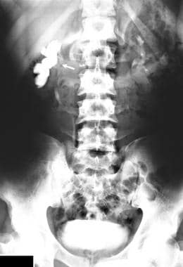 A 21-year old man presented with a history of inte