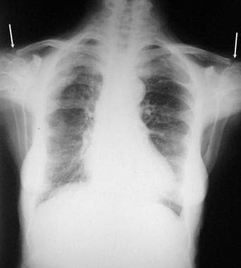 Posteroanterior (PA) chest radiograph in a 60-year