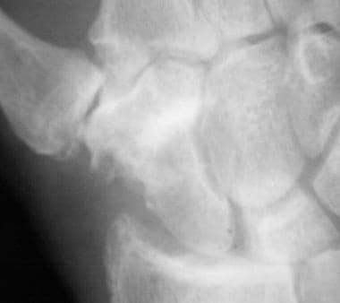 Close-up radiograph of the wrist shows osteoarthri