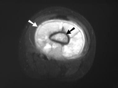 Axial short-tau inversion recovery (STIR) MRI. The