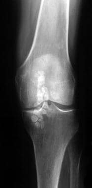 Frontal radiograph of a patient with synovial oste