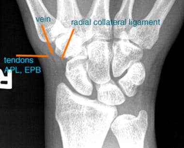 Image shows a normal scaphoid fat stripe. Fat is s
