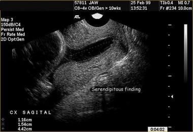 Sonography shows an incidental finding of a short 