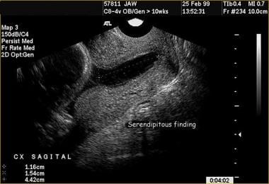 Funneling | Ultrasound sonography, Obstetric ultrasound, Medical ultrasound