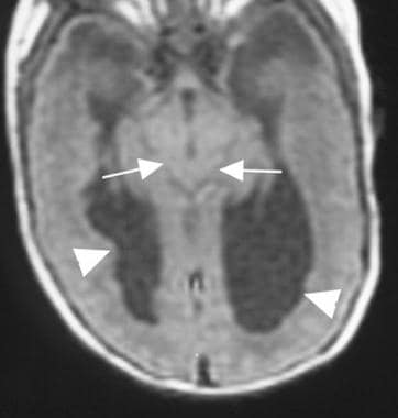 Axial T1-weighted magnetic resonance image in a pa