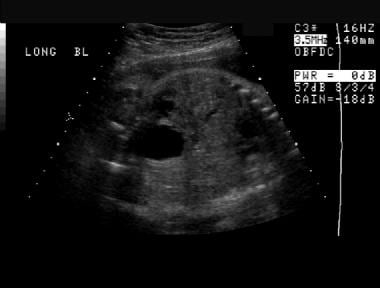 Prenatal sonogram almost in the coronal plane. A d