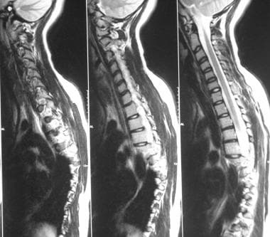 MRIs show cervical scoliosis. 