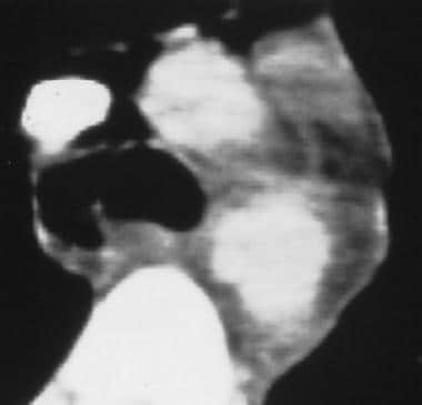 Aorta, trauma. CT scan shows a focal isthmus pseud