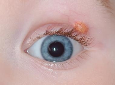 Juvenile Xanthogranuloma Iris