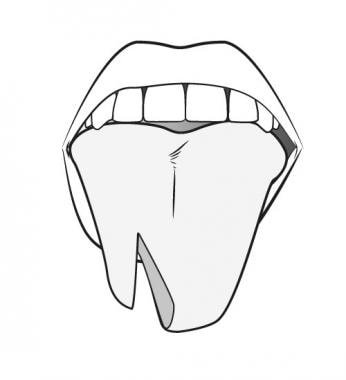 Bisected tongue. 