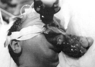 This photograph shows an infant with epignathus. E