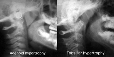 Plain radiographs of patients with adenoid hypertr