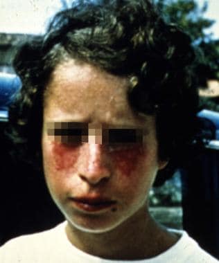 A young patient with Bloom syndrome showing the ty