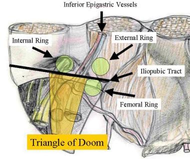 Laparoscopic Inguinal Hernia Repair Triangle Of Doom