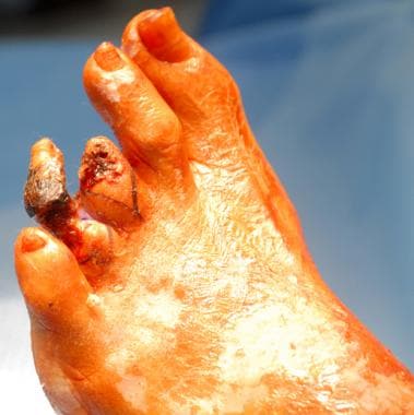Adjacent toe amputations: anterior view of markup.