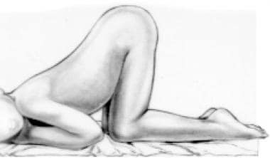 frog leg position examination