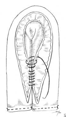 Bladder Augmentation (Cystoplasty): Procedure & Recovery