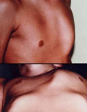 10-year study shows brace treatment is best for Pectus carinatum