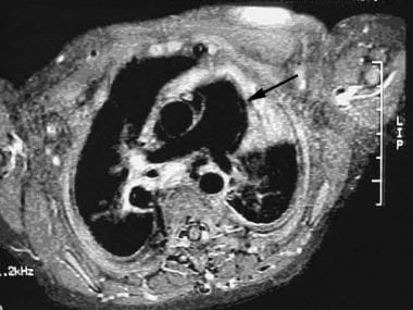 MRI of the same patient (a 10-month-old child afte