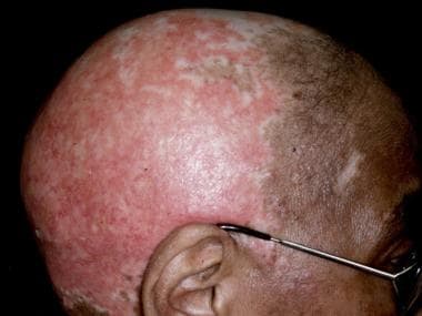 Widespread scarring alopecia. 
