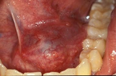 mucocele floor of mouth