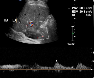 B-1: Extrahepatic artery Doppler ultrasonography s