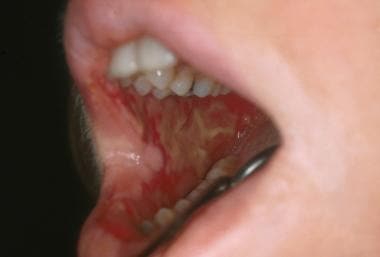 Ulcerative oral mucositis lesion on the buccal muc