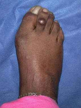 Foot Corn Treatment & Callus Removal for the Elderly