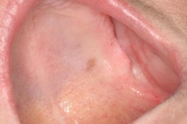 malignant melanoma mouth