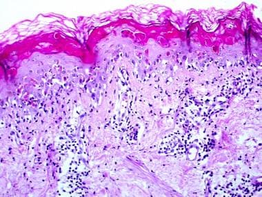 Interface dermatitis with prominent dyskeratotic c