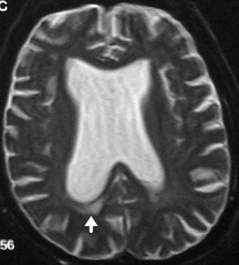 T2-weighted MRI showing dilatation of ventricles o