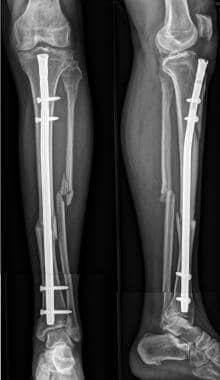 Tibial Diaphysis Fracture