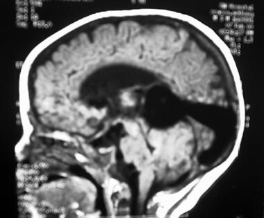 Cranial MRI showing flow void in the sagittal plai