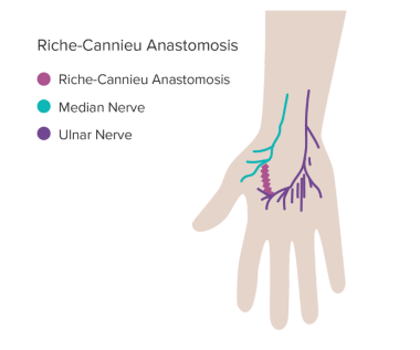 Ulnar Nerve Transposition Lee's Summit