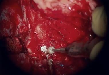 The tumor debulking is performed using the micro-i