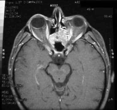 MRI of same patient as in the image above taken 4 
