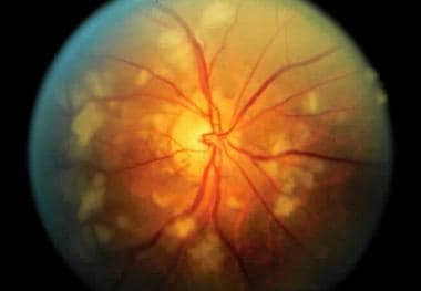 Characteristic fundus findings of Purtscher retino