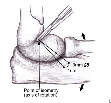 LUCL (lateral ulnar collateral ligament) isometric