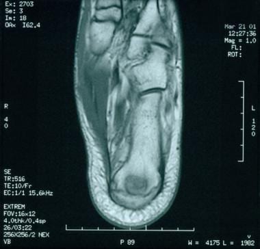 Transverse MRI of foot in symptomatic 11-year-old 