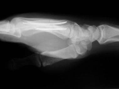 metacarpal x ray