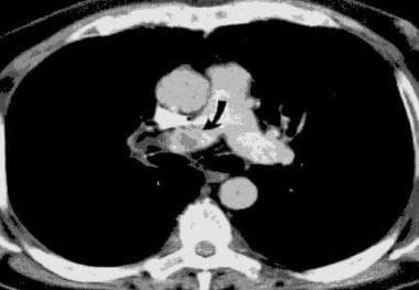 Venous Thromboembolism (VTE). Helical CT scan of t